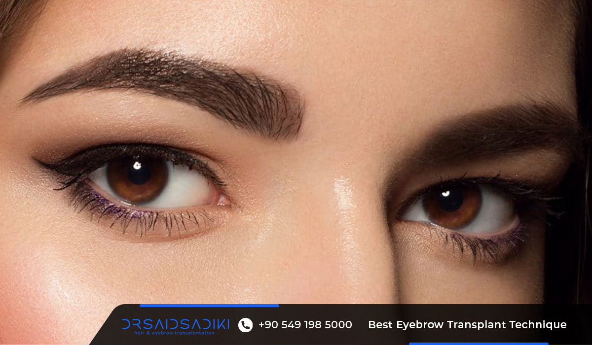 Before and after best eyebrow transplant technique using LOFT