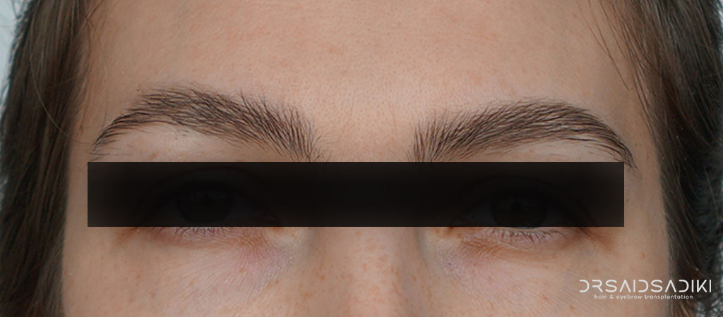 Eyebrow Transplant Gone Wrong: Causes, Mistakes & How to Avoid Them 24 Correcting a failed eyebrow transplant using LOFT technique