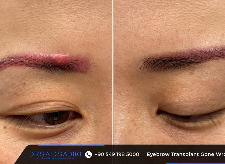 Eyebrow Transplant Gone Wrong