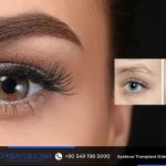 Eyebrow Transplant Side Effects in the UK & USA – Full 2025 Safety Guide 13 Eyebrow Transplant Side Effects