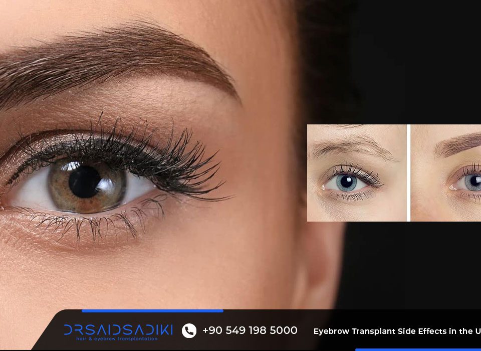 Eyebrow Transplant Side Effects