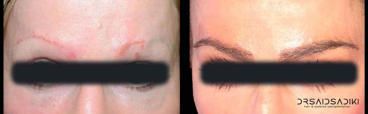 Eyebrow transplant side effects before and after