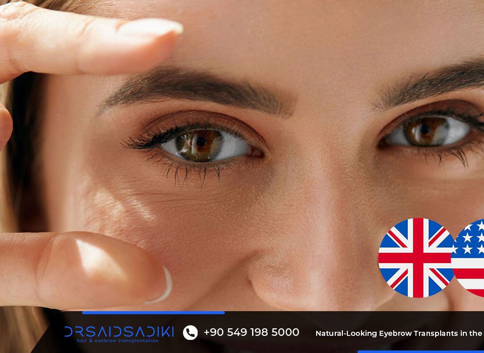 Natural-Looking Eyebrow Transplants